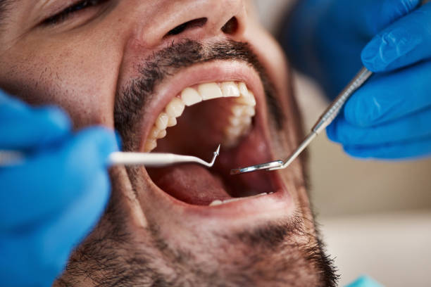 Best Emergency Tooth Extraction in Salina, OK